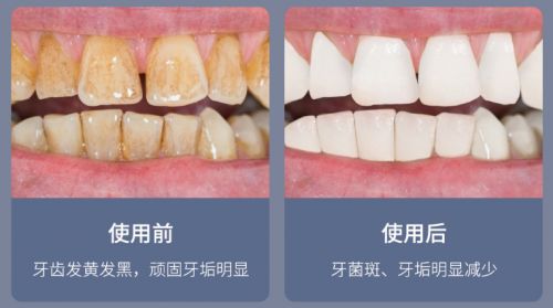 告別刷牙盲區(qū)，現(xiàn)代口腔護(hù)理新選擇 為何它能解決你的深層困擾